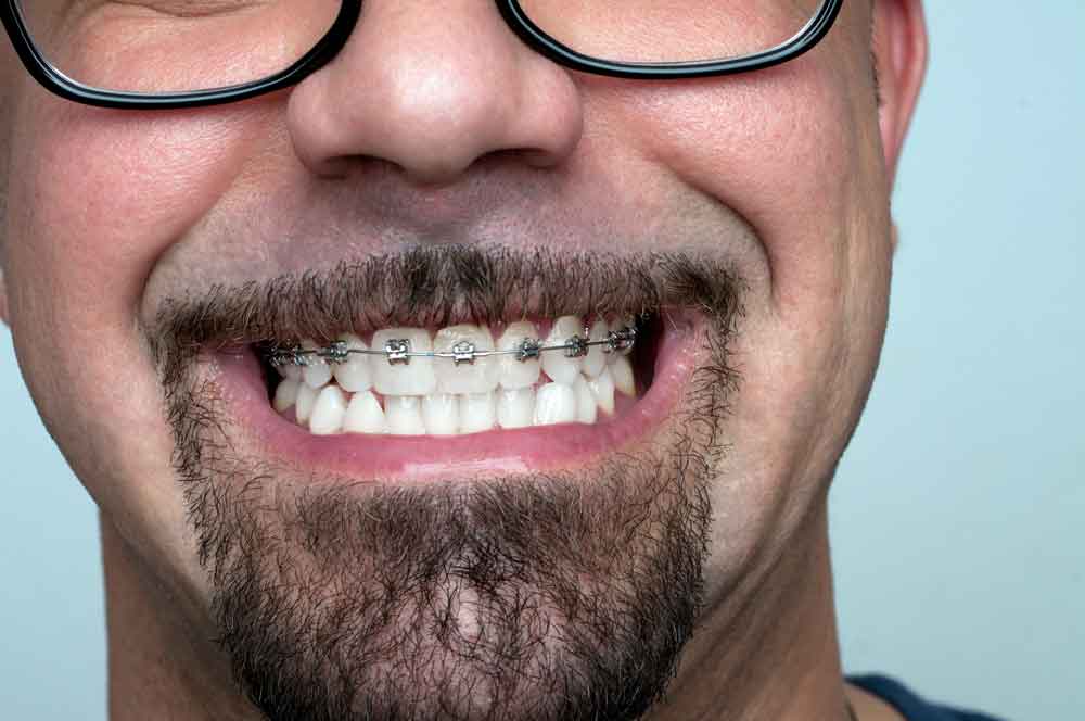 How Much Do Braces Cost?