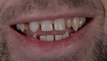 permanent vampire teeth caps